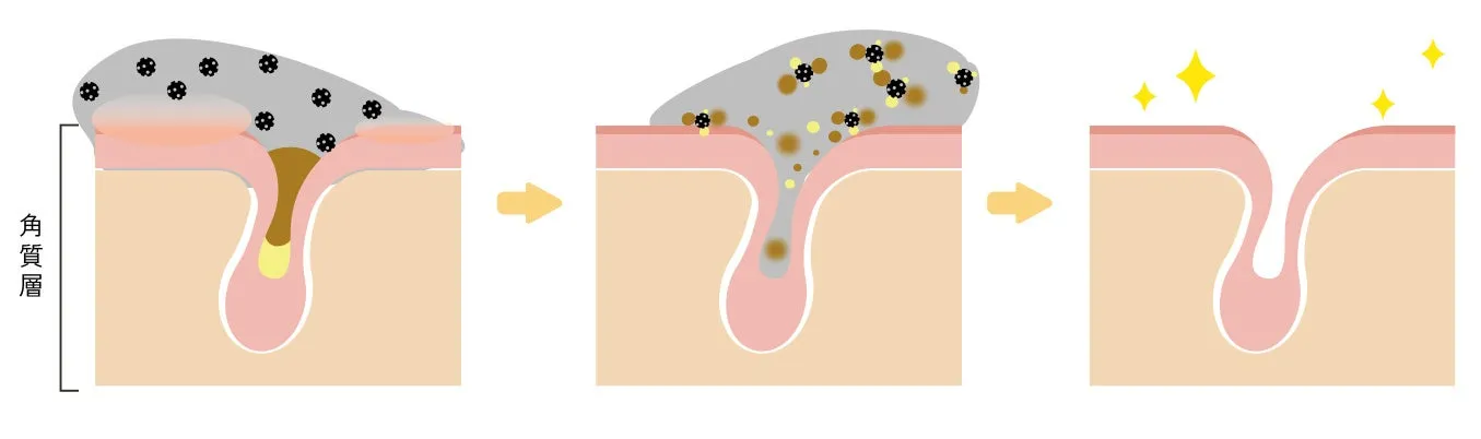 毛穴の詰まりとケアのプロセスを説明するイラスト
